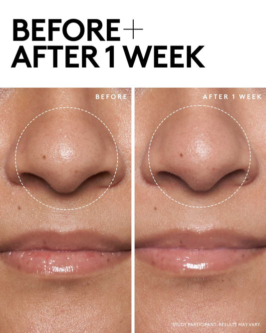 before and after effects within a week of using Cookies and Clean Face Scrub showing smaller pores.